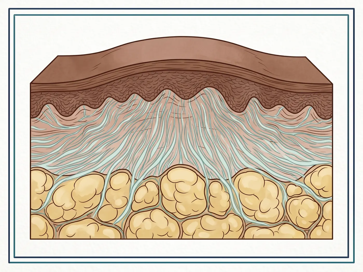 ภาพวาดประกอบ: ภาคตัดขวางผิวหนังแสดงการบวมของเนื้อเยื่อชั้นลึก (angioedema) เทียบกับผื่นลมพิษชั้นตื้น (ไม่ใช่ภาพถ่ายทางการแพทย์)