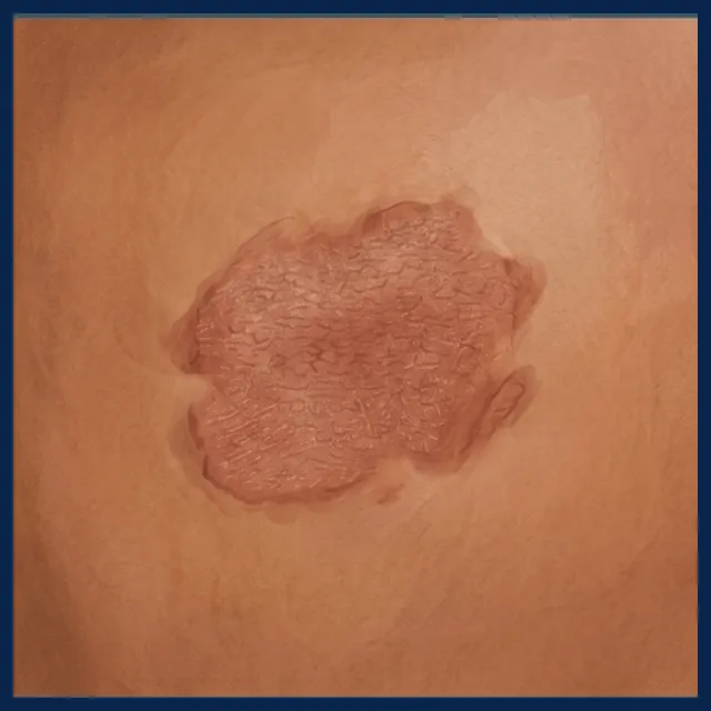 ภาพวาดประกอบ: ผื่นผิวหนังอักเสบ (eczema)